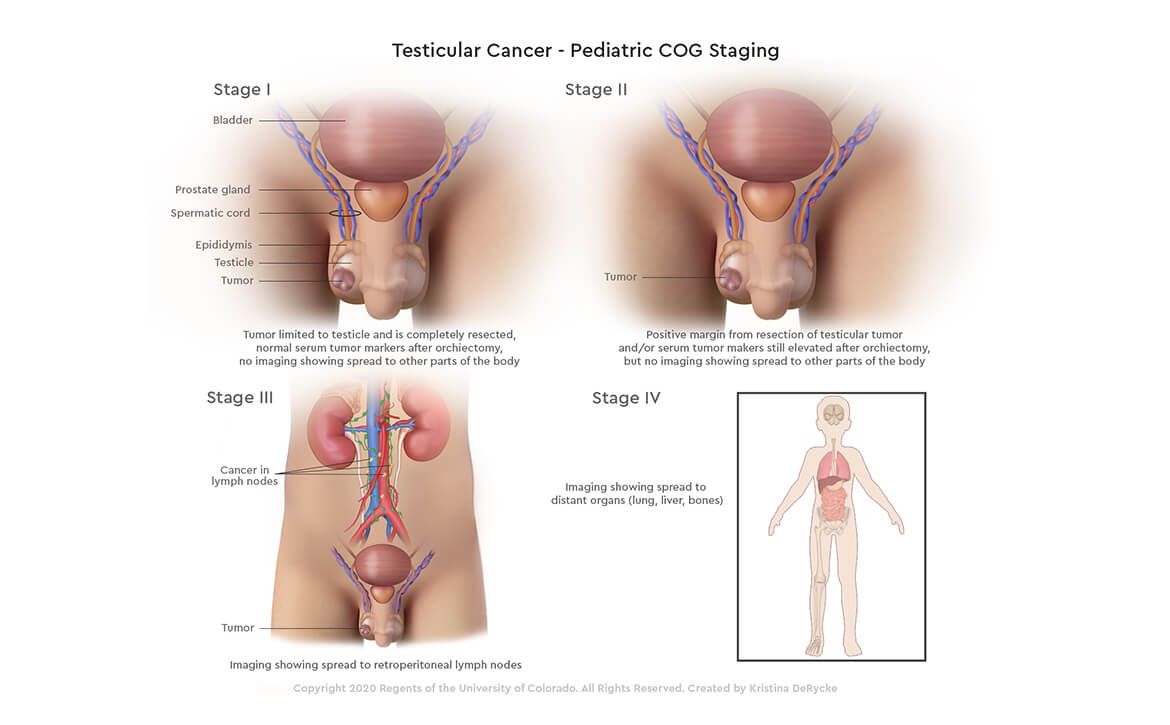 Best Pediatric Urologist in India, Robotic pediatric urology